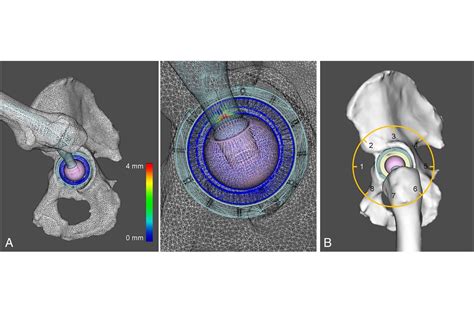 motion capture used to assess best sexual positions after hip surgery