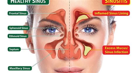 home remedies  sinus drainage