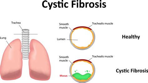 New Gene Therapy Could Treat Cystic Fibrosis With One Dose