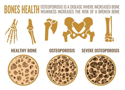 world osteoporosis day  mountain ice joint  bone health complex mountain ice pain
