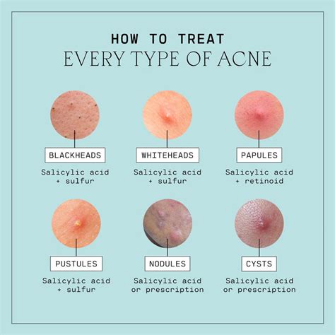 Types Of Acne Explained – Versed Skin