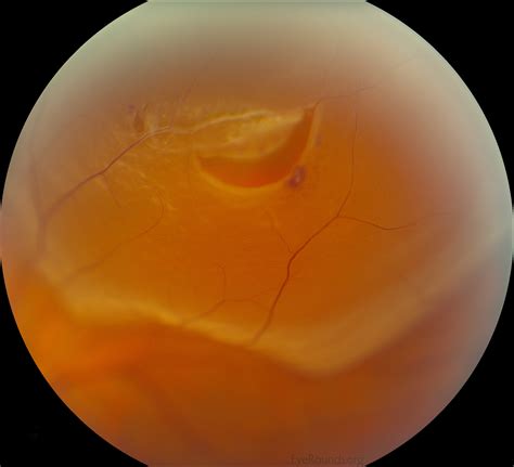 vitreous syneresis  impending posterior vitreous detachment pvd