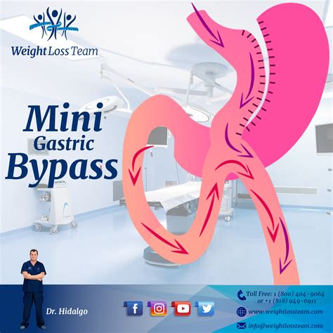 Mini Gastric Bypass What Is The Mini Gastric Bypass