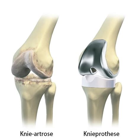 knieprothese wat  het en welke soorten zijn er