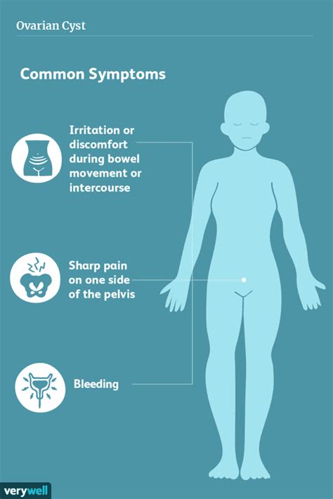 ruptured ovarian cysts diagnosis treatment and more