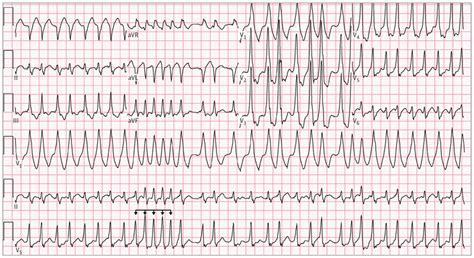 A Rapid Irregular Rhythm In A Healthy Young Patient How Fast Can You