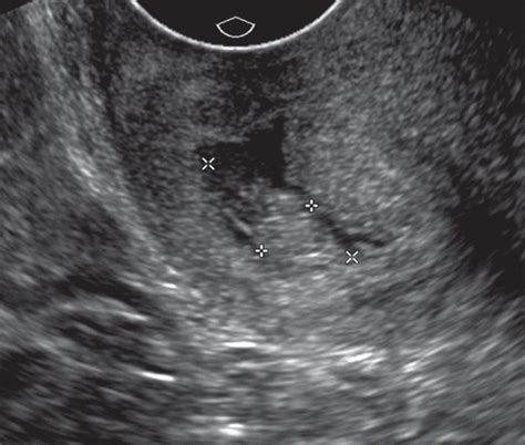 us of the nongravid cervix with multimodality imaging correlation