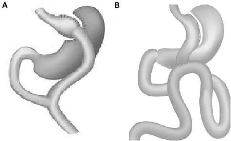 Comparison Of One Anastomosis Gastric Bypass And Roux En Y