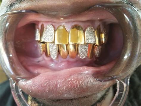 gold crowns gold dental work mobile al