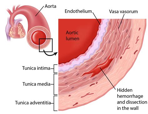 heart tamponade  aortic dissection medical illustration human body