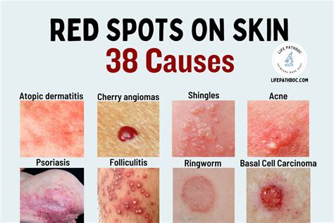 red spots  skin   pictures  treatment