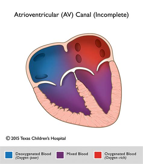 partial atrioventricular canal av canal pediatric echocardiography