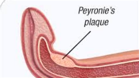 peyronie s disease symptoms causes treatment surgery youtube