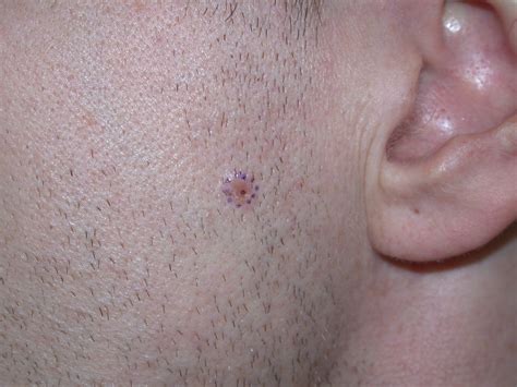 basal cell carcinoma bcc acd