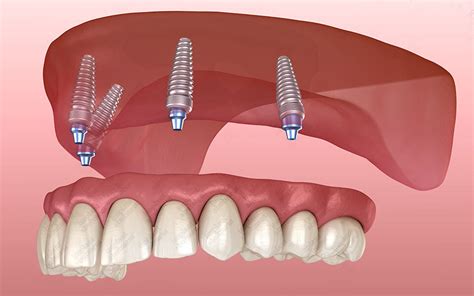 clean    implants implant abutment