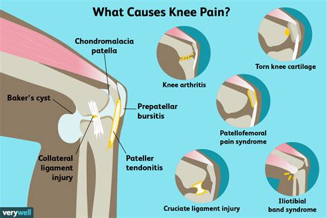 Knee Pain Causes Diagnosis And Treatment
