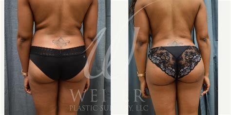brazilian butt lift before and after photos patient 247