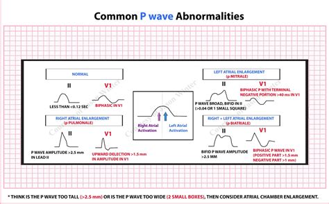 ecg educator blog p wave abnormalities
