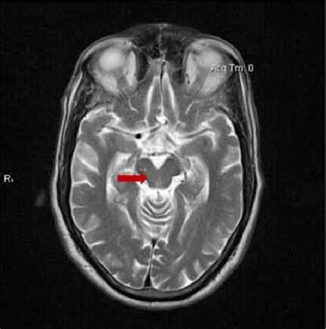 brain mri   patient showing measurement   midbrain  pons  scientific