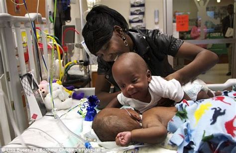 conjoined twins joshua and jacob spates say hello after