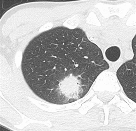 Figure 4 From High Resolution Ct Findings Of Pulmonary Infections In