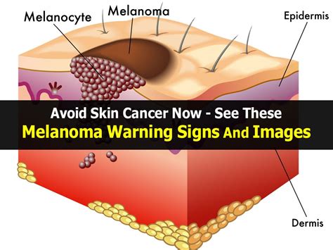 avoid skin cancer now see these melanoma warning signs