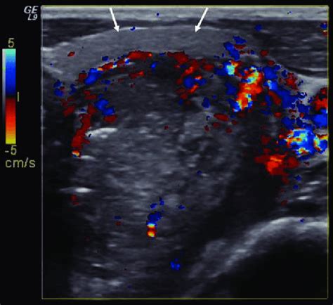 transverse us scan of the cervix shows a large mass with focal areas