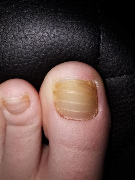 whys  toenail forming multiple layers curious     started   rmedicaladvice