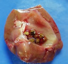 Image result for kidneys stones