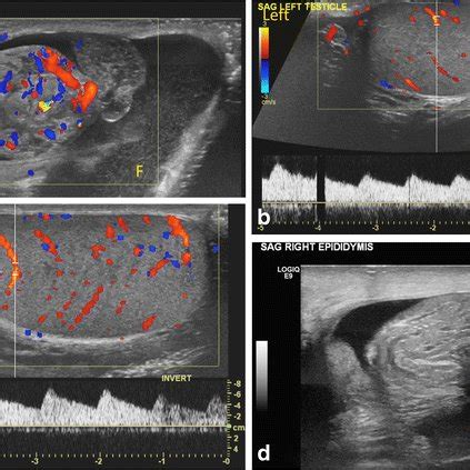 testicular torsion  preserved flow key sonographic features   added approach