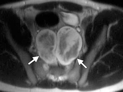 Uncommon Primary Pelvic Retroperitoneal Masses In Adults A Pattern