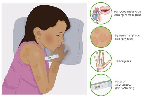 rheumatic fever clinical concise medical knowledge
