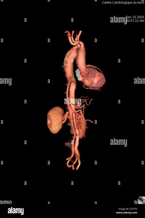 aneurysm aorta  scan fotos und bildmaterial  hoher aufloesung alamy