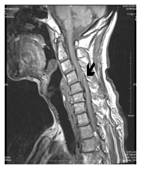 Paraplegia After Gastrectomy In A Patient With Cervical Disc Herniation