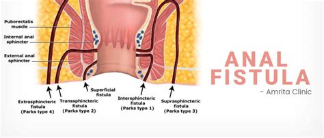 what is anal fistula amrita clinic