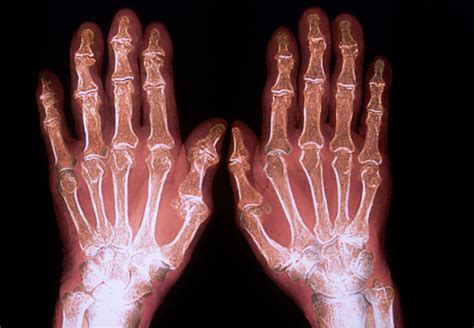 undifferentiated arthritis identifying candidates  early treatment
