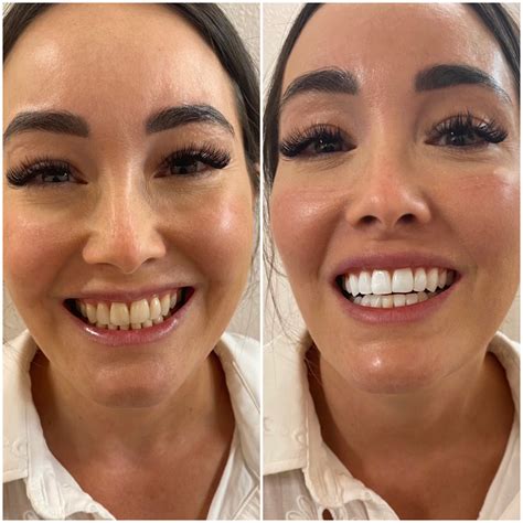 close pores  teeth  whitening expert tips  tricks