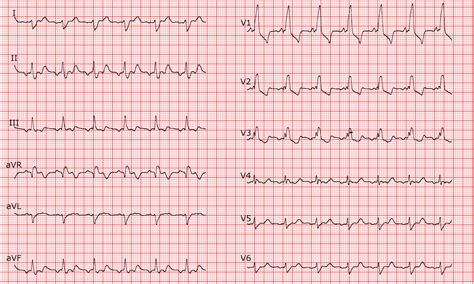 [cardio Fr] Atrial Flutter With 2 1 Conduction And Rbbb