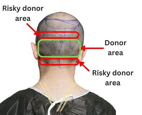 care  donor area   hair transplant post op care