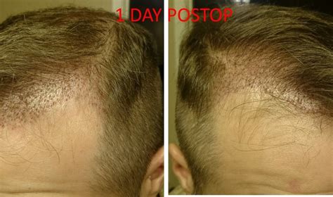 fue  sessions front  crown  grafts  grafts hair transplant reviews hair