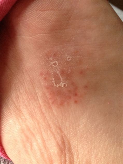 small bump bottom of foot that itches horribly porno photo