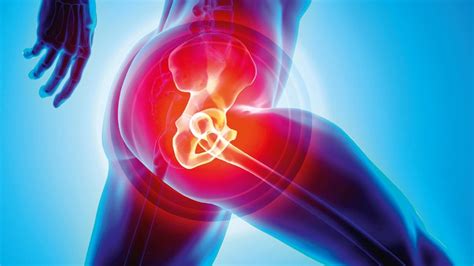 Hip Replacement The Pros And Cons Of Early Surgery The