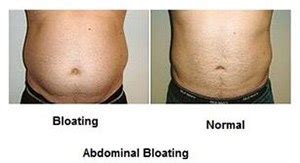 abdominal bloating treatments london bloated stomach london