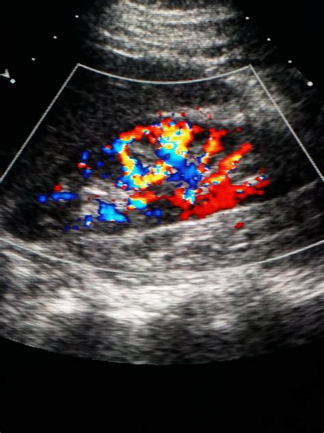 doppler ultrasound   ultrasound  color shows blood flow   kidney