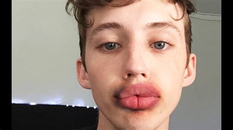 kylie jenner lip challenge gone wrong famous person