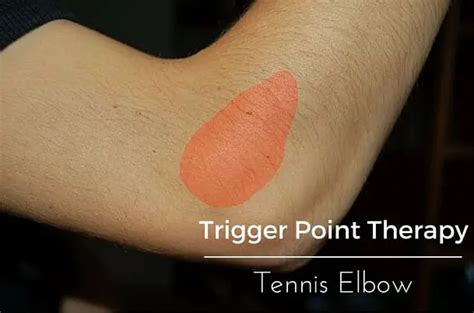 trigger point therapy tennis elbow for your massage needs