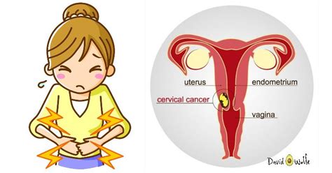 most women miss these 3 early signs of cervical cancer david avocado