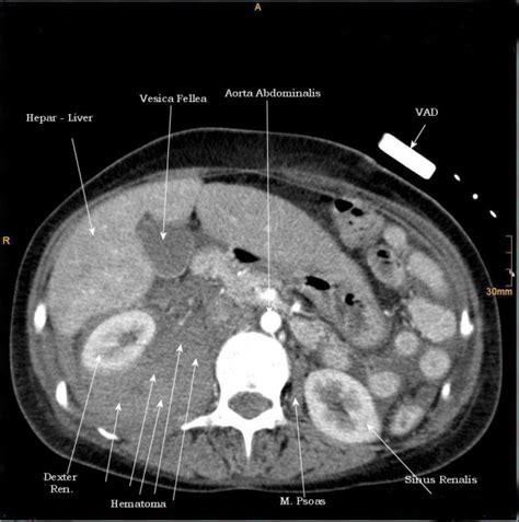 1st Case Ct Axial Plan Demonstrating A Retroperitoneal Hematoma