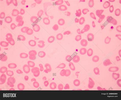 thalassemia blood smear abnormal red blood cells morphologymedical