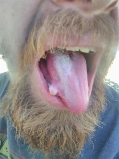 bit tongue  months   seizure     growth